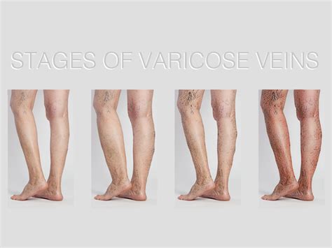 The Four Stages Of Varicose Veins And How To Spot Them Early Denver