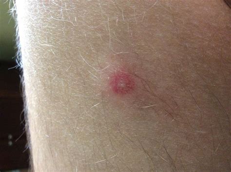 Doctors help recognize, prevent, and treat allergies: How to Identify a Spider Bite: 7 Steps (with Pictures ...