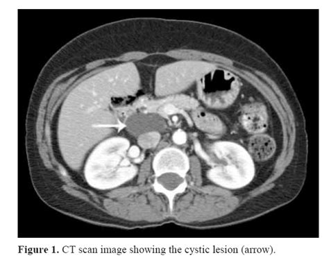 Recurrence Of A Pancreatic Cystic Lymphangioma After Diagnosis An