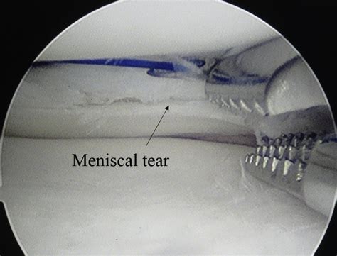 Right Knee Internal View Of The Medial Compartment Using The