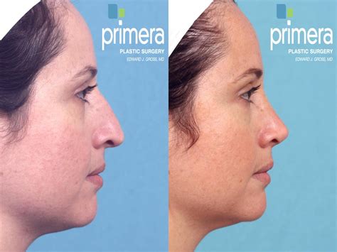 Rhinoplasty Before And After Pictures Case 360 Orlando Florida Primera Plastic Surgery