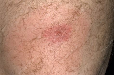 Horsefly Bite Stock Image M3200464 Science Photo Library