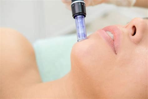 The Benefits Of Microneedling Treatments Timeless Aesthetics Llc