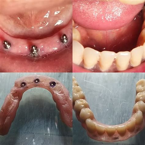 Pin En Implantes Dentales