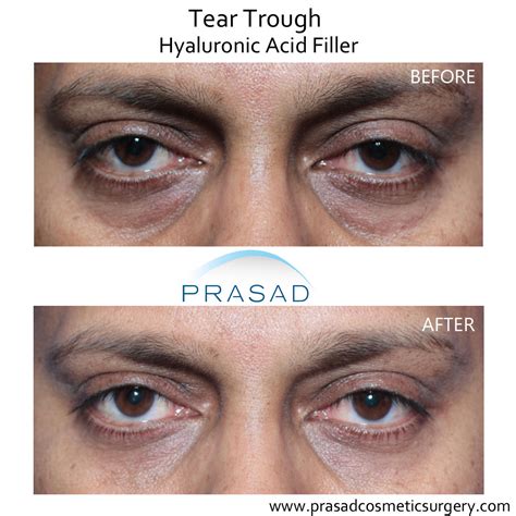Under Eye Filler For Hollow Eyes Tear Troughs And Eye Bags