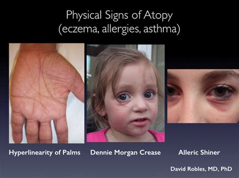 Atopic Dermatitis Aka Eczema By David Robles Md Phd