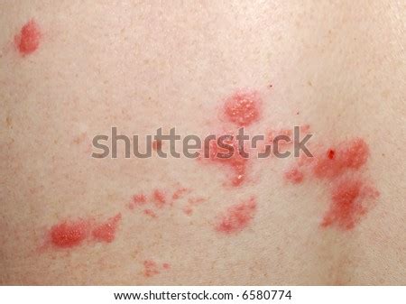 Ethos is a family of synthesizable neural processor ips designed by arm for iot and edge applications. Shingles Sores Stock Photo 6580774 : Shutterstock