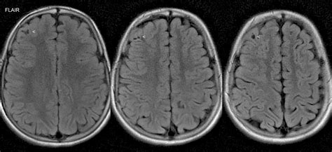 My Brain Mri Showing White Matter Lesions Caused By L
