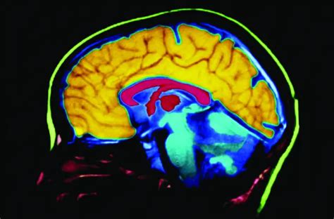New ‘breakthrough Alzheimers Treatment Restores 75 Of Memory