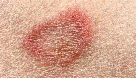 Ringworm Healing Stages Causes Diagnosis And Treatment