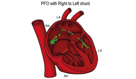 The Heart And Patent Foramen Ovale Pfo Anatomy Of A Diver British