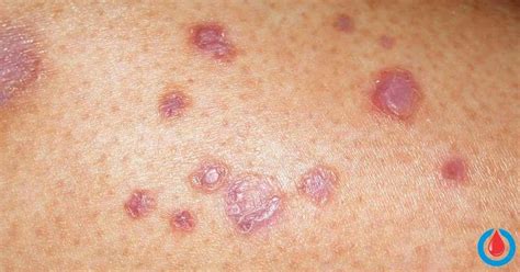 The Most Common Skin Problem In People With Diabetes Is Called Diabetic