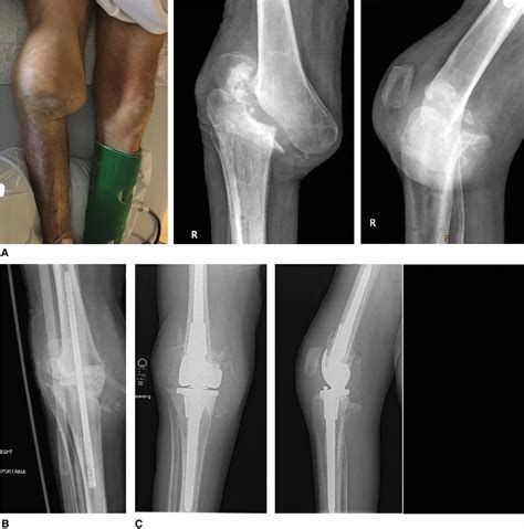 Neuropathic Charcot Arthropathy Of The Knee Jaaos Journal Of The