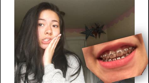 Getting My Braces Off Vlog 2018 Youtube