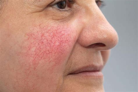 Rosacea And Facial Redness Causes Removal And Treatment Auckland