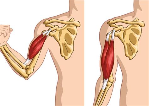 Biceps Tendon Disorders Orthopedic Shoulder Specialist Vail Aspen