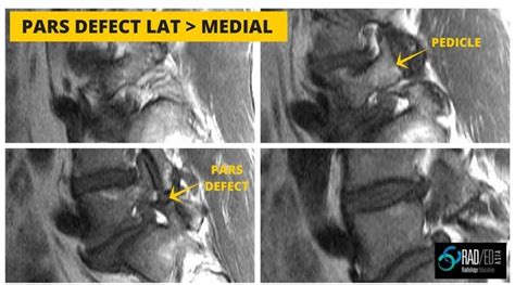 Pars Defects How To Find Them Easily On Mri Radedasia