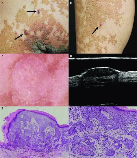Ab Clinical Presentation 2 Violaceous Papules On The Medial Of The