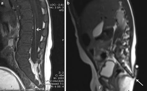 Proposed caudal appendage classification system; spinal cord tethering