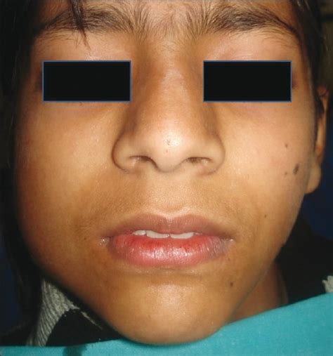 Preoperative View Swelling At The Right Mandibular Angle Region