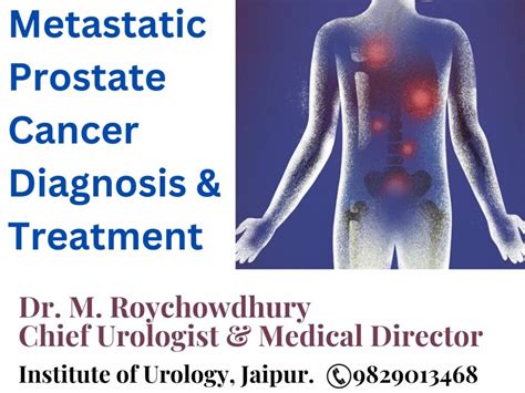 Metastatic Prostate Cancer Diagnosis Treatment