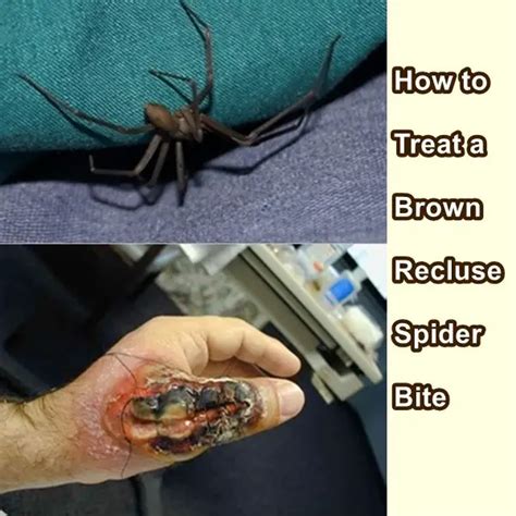Skin Brown Recluse Spider Bite