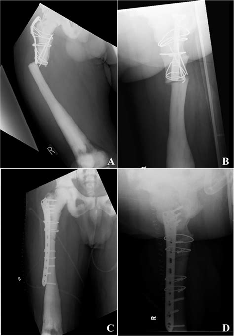 Anteroposteriorap A And Lateral B Radiographs Of The Right Femur