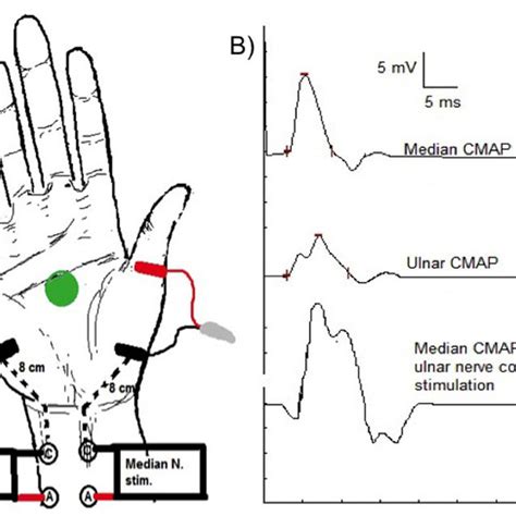 Median And Ulnar Motor Nerve Conduction Studies Recording Abductor
