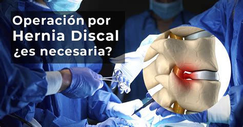 ¿la Operación Por Hernia Discal Es Necesaria Cordus Colombia