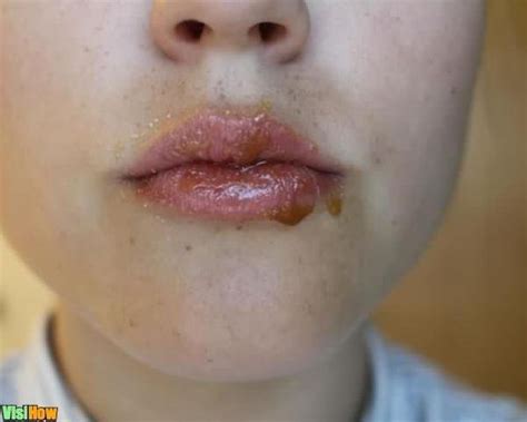 Get Rid Of Blackheads On Your Lips With White Toothpaste And A
