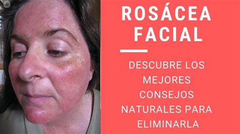 Remedios Caseros Para La Rosácea Facial Que Es La Rosácea Facial Causas De La Rosácea Facial