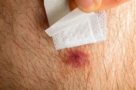 How To Remove Scars Caused By Insect Bites Livestrongcom
