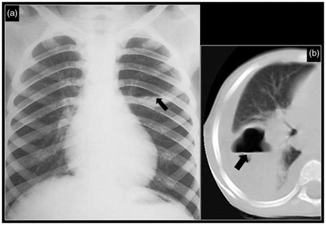 Lung Abscess Two Different Immunocompromised Patients Demonstrating A