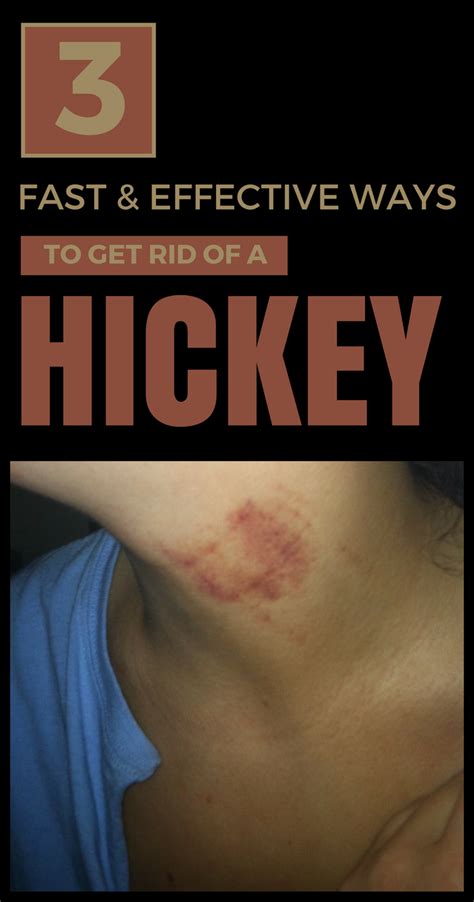 3 Fast And Effective Ways To Get Rid Of A Hickey Nails Beauty
