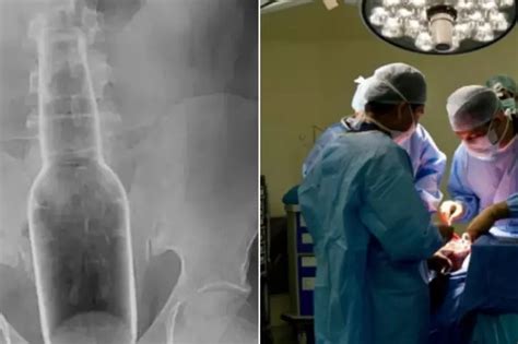 Chinese Man Gets 7 Inch Long Glass Bottle Stuck In His Rectum After He Used It For Scratching