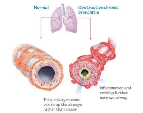 Chronic Obstructive Pulmonary Disease COPD Island Health