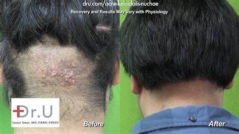Barbers Rash Back Of Head Acne Keloidalis Nuchae Akn Cure Youtube