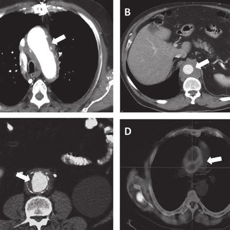 Thoracoabdominal Ct Scan Contrast Enhanced Ct Scan Axial Views