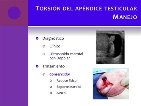 Torsion Testicular