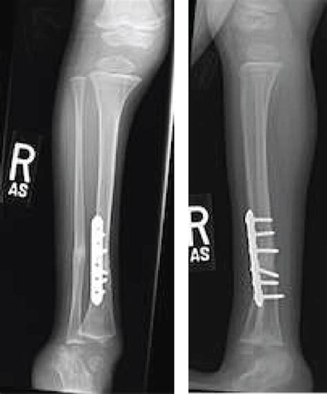 Supramalleolar Derotational Osteotomy In A 3 Year Old Male Fixed With
