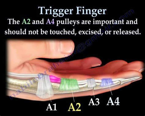 Trigger Finger And Trigger Thumb Everything You Need To Know Dr