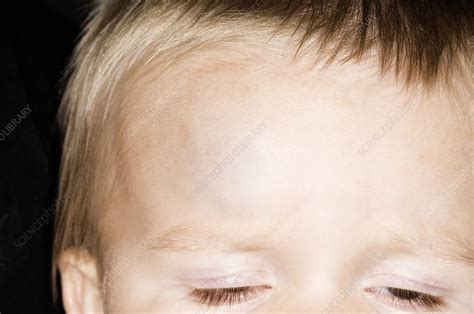 Bump On The Forehead In A Child Stock Image C0090127 Science