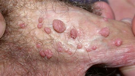 Female Genital Warts