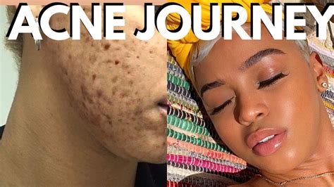 How To Treat Acne Hormonal Cystic Hyperpigmentation Acne On Black