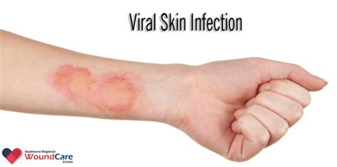 Skin Infection Causes Symptoms And Treatment In Lubbock Tx