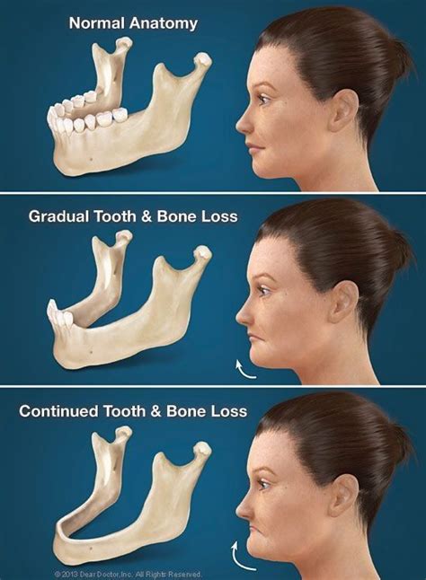 When You Lose Your Teeth Your Jaw Bone Slowly Deteriorates Away Which