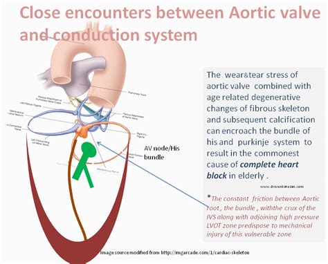 Right Aortic Valve