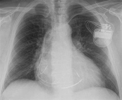 Clicking on any result will. Kardiologie - Herzschrittmacher, Defibrillatoren, kardiale ...