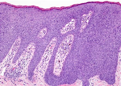 Pathology Outlines Bowenoid Papulosis