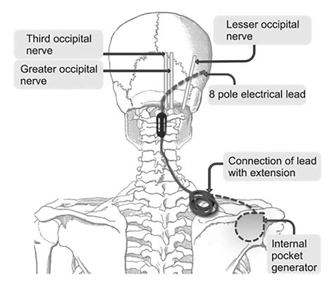 Gary Brinsons Path To Headache Relief The Power Of Occipital Nerve